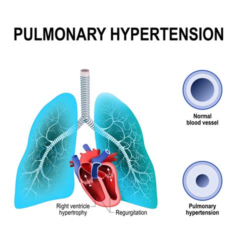pulmoner hipertansiyonun prognozu